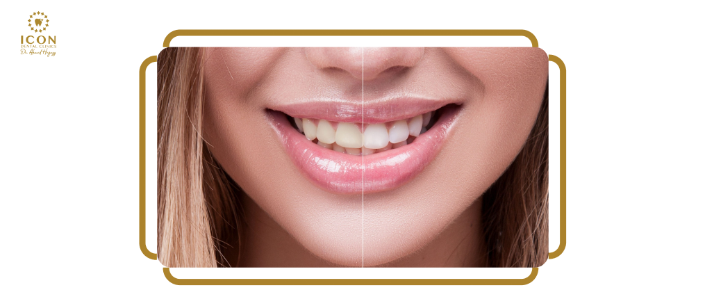 تبييض الاسنان